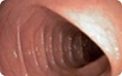 An image of the entire mucosa of colon segment with no residual staining, small fragments of stool or opaque liquid