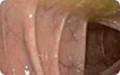 An image of the entire mucosa of colon segment with minor residual staining, small fragments of stool and/or opaque liquid