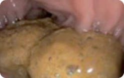 An image of a portion of the mucosa of colon segment seen, but other areas not well seen due to staining, residual stool and/or opaque liquid