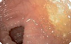 An image of the entire mucosa of colon segment with minor residual staining, small fragments of stool and/or opaque liquid