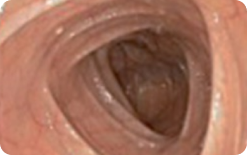 An image of the entire mucosa of colon segment with no residual staining, small fragments of stool or opaque liquid