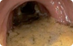 An image of a portion of the mucosa of colon segment seen, but other areas not well seen due to staining, residual stool and/or opaque liquid
