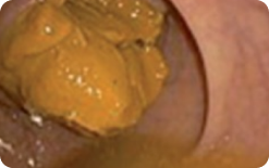 An image of an unprepared colon segment with mucosa not seen due to solid stool that cannot be cleared
