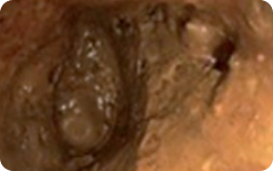 An image of an unprepared colon segment with mucosa not seen due to solid stool that cannot be cleared